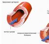 Можно ли вылечить синдром позвоночной артерии при остеохондрозе